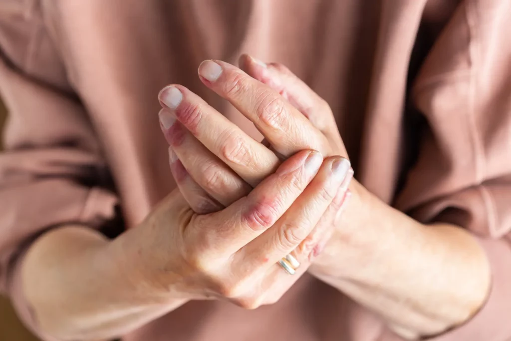 3 Common Misconceptions About Hand Osteoarthritis (OA):